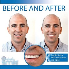 Instant Smile Temporary Tooth Kit – Pro-Series
