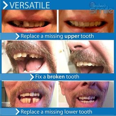 Instant Smile Temporary Tooth Kit – Pro-Series